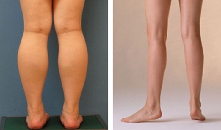 Cùng Dinh Dưỡng Thể Hình tìm hiểu về nguyên nhân bắp chân to và cách giải quyết vấn đề bắp chân to vô cùng đơn giản mà bạn chưa biết tới....